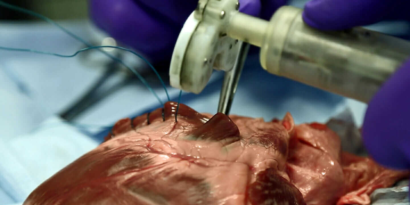 A 3D-printed device makes the minimally invasive yet delicate keyhole heart surgery process easier for surgeons.